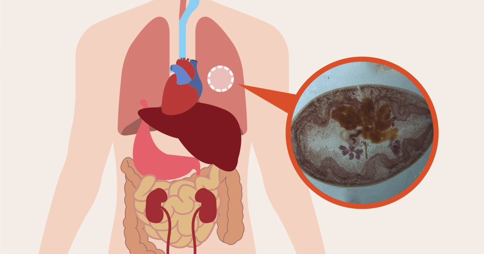 폐에 기생하는 폐디스토마(폐흡충)